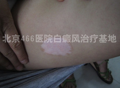 北京白癜风医院:女性腿部白癜风5年 北京白癜风医院:女性腿部白癜风5年