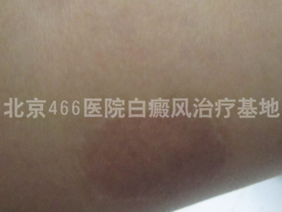北京白癜风医院:女性腿部白癜风5年 北京白癜风医院:女性腿部白癜风5年
