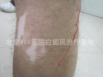 北京白癜风专科医院:男性腿部白癜风8年 北京白癜风专科医院:男性腿部白癜风8年