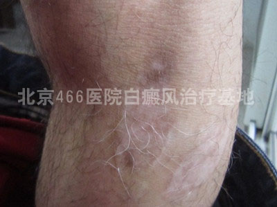 北京白癜风专科医院:男性腿部白癜风8年 北京白癜风专科医院:男性腿部白癜风8年