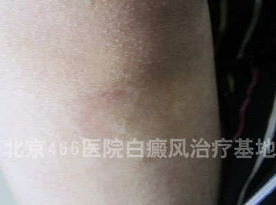 北京466白癜风医院:女性腿部局限白癜风2年 北京466白癜风医院:女性腿部局限白癜风2年