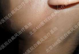 北京466白癜风医院:女性侧脸、耳边白癜风2年 北京466白癜风医院:女性侧脸、耳边白癜风2年