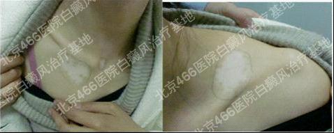 北京466医院白癜风治疗基地：女性颈部白癜风一年