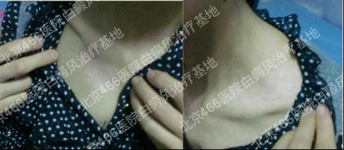 北京466医院白癜风治疗基地：女性颈部白癜风一年