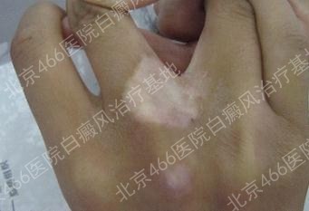 北京466医院白癜风治疗基地：女性手部白癜风2年